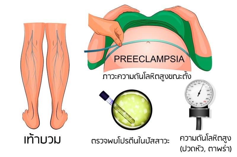 ข้อเท้าบวมตั้งครรภ์