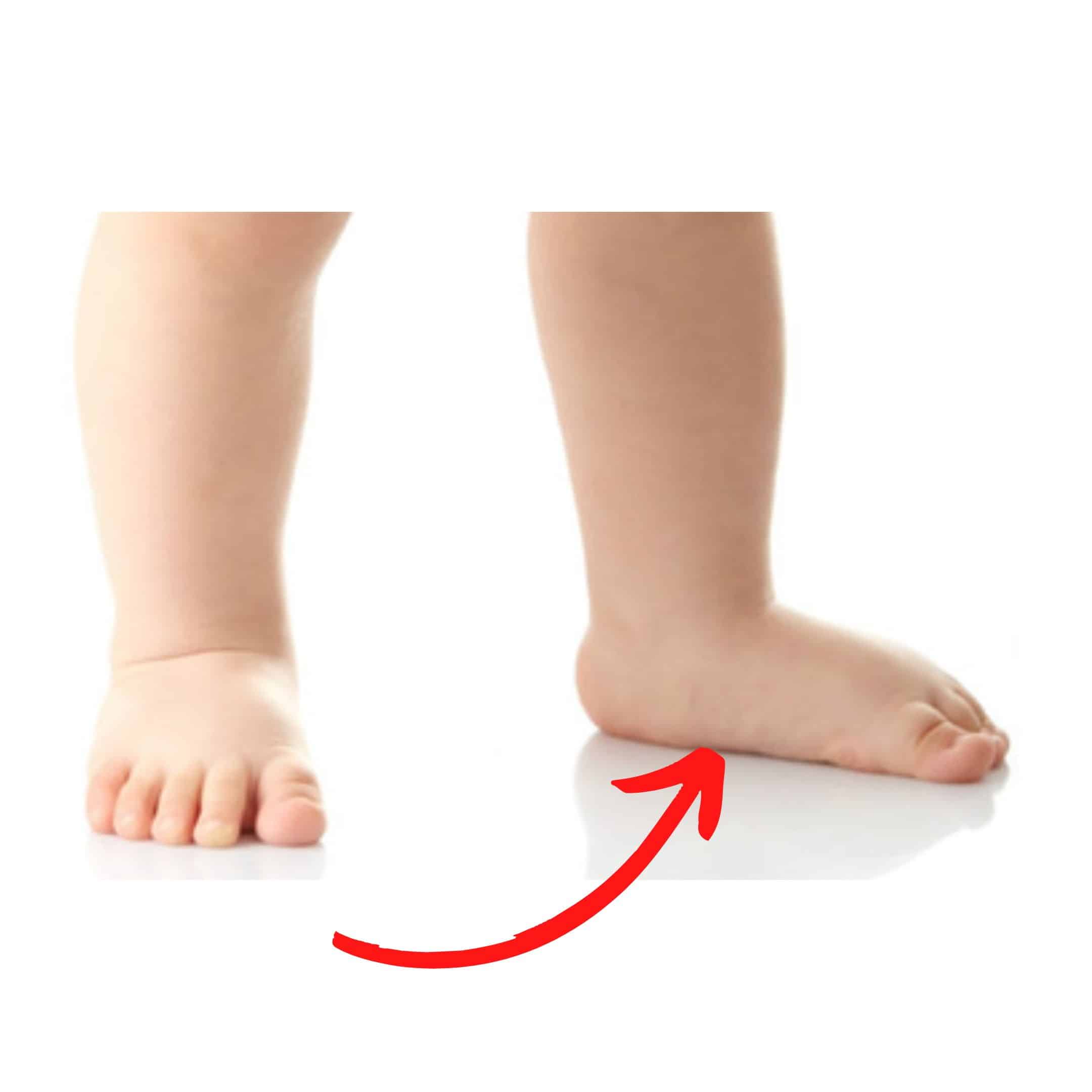 เท้าแบนในเด็กมีไขมันอุ้งเท้า