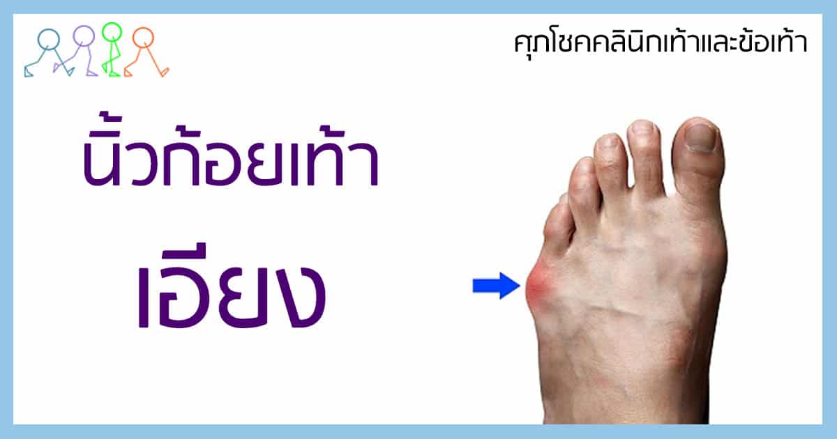 ปลายนิ้วก้อยเท้าเอียง