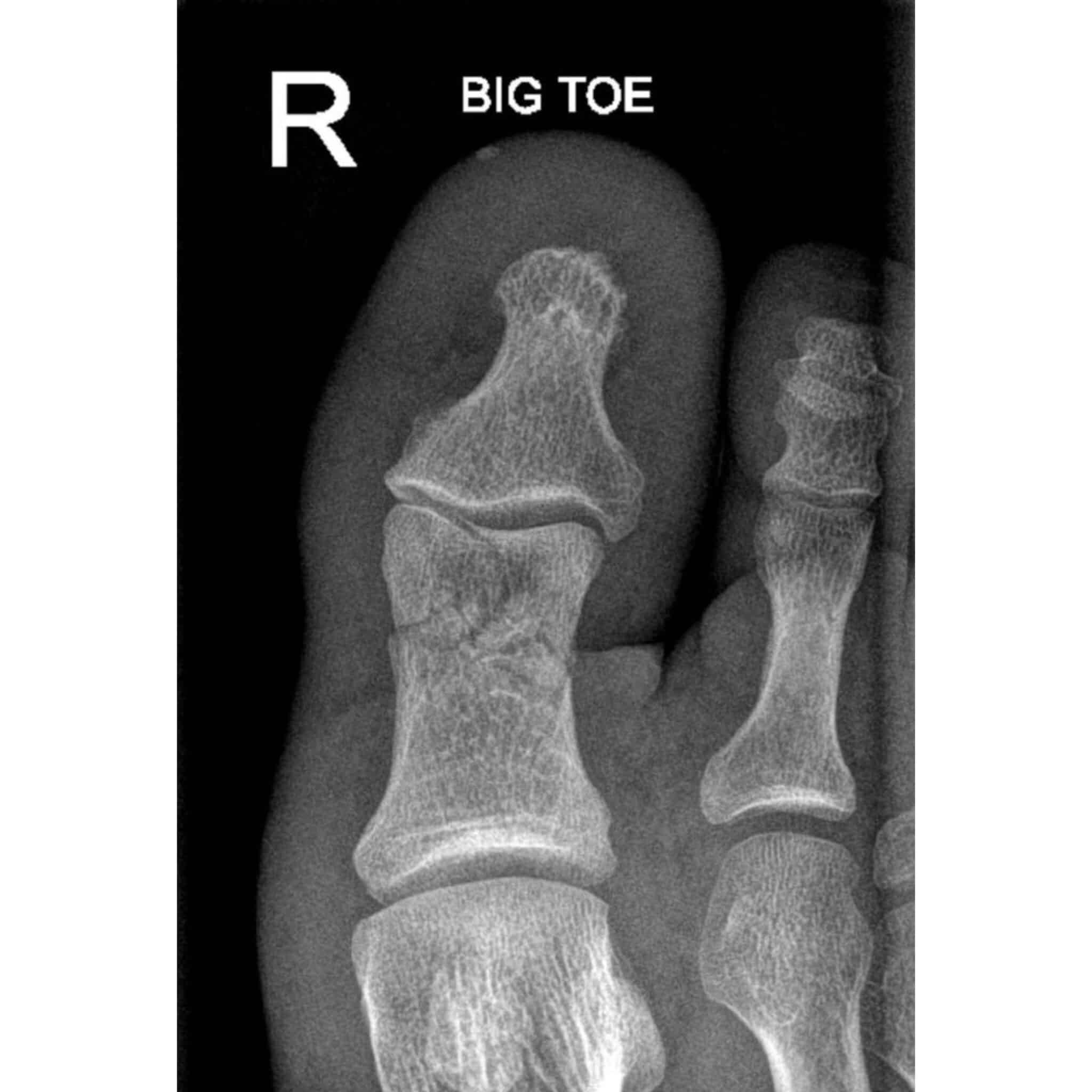 เล็บเท้าห้อเลือด รักษาอย่างไร ต้องถอดเล็บไหม ทำยังไงถึงจะหายปวด