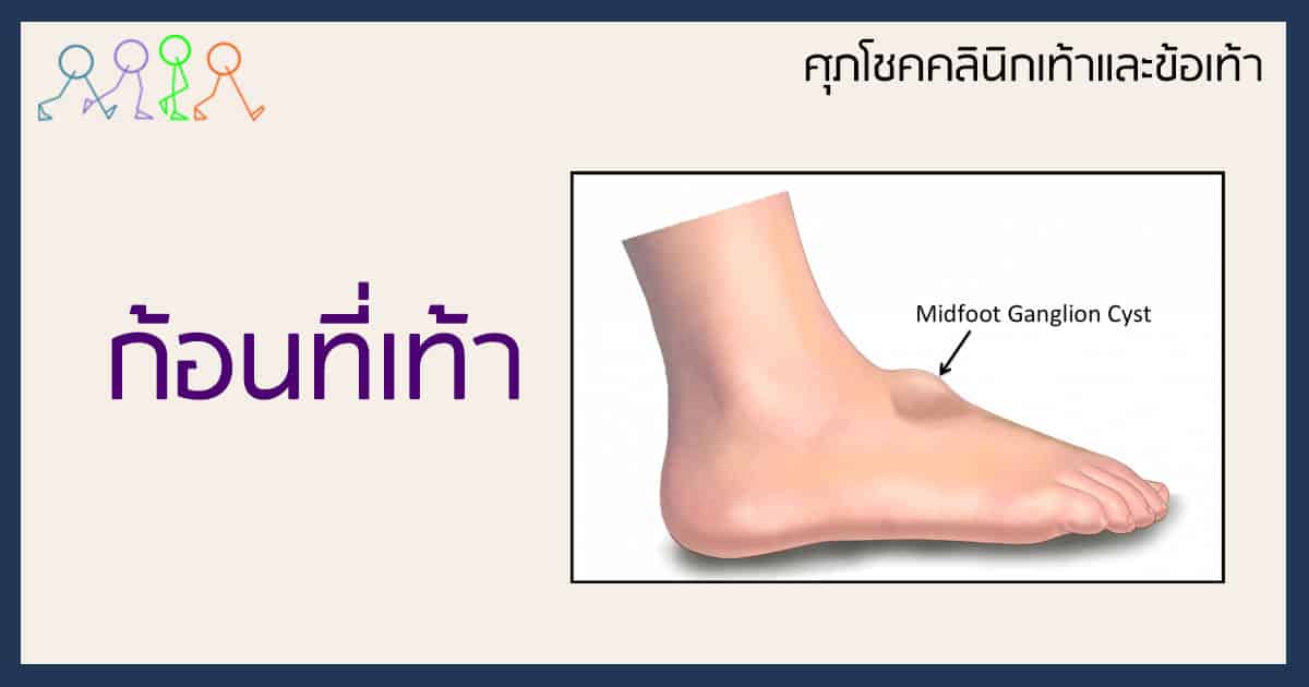 ก้อนที่เท้า